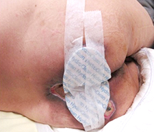 壓力性損傷(褥瘡、壓瘡、壓傷)治療