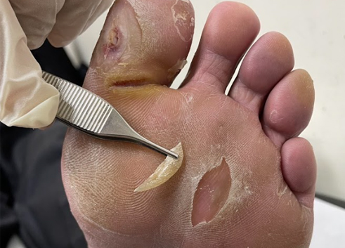 糖尿病足