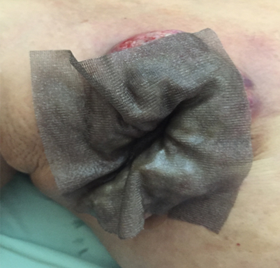 癌症腫瘤傷口照護