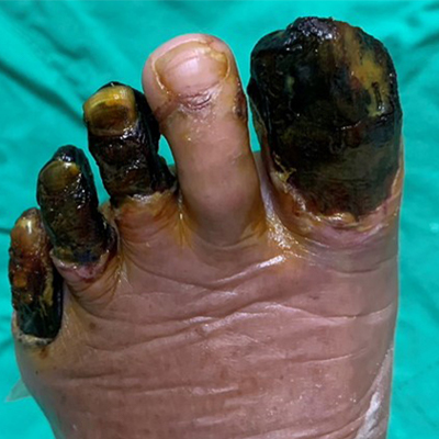 足部潰瘍的危險因子